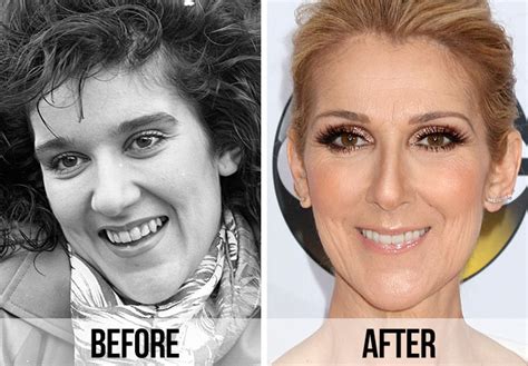 celine dion fake teeth|celine dion before and after surgery.